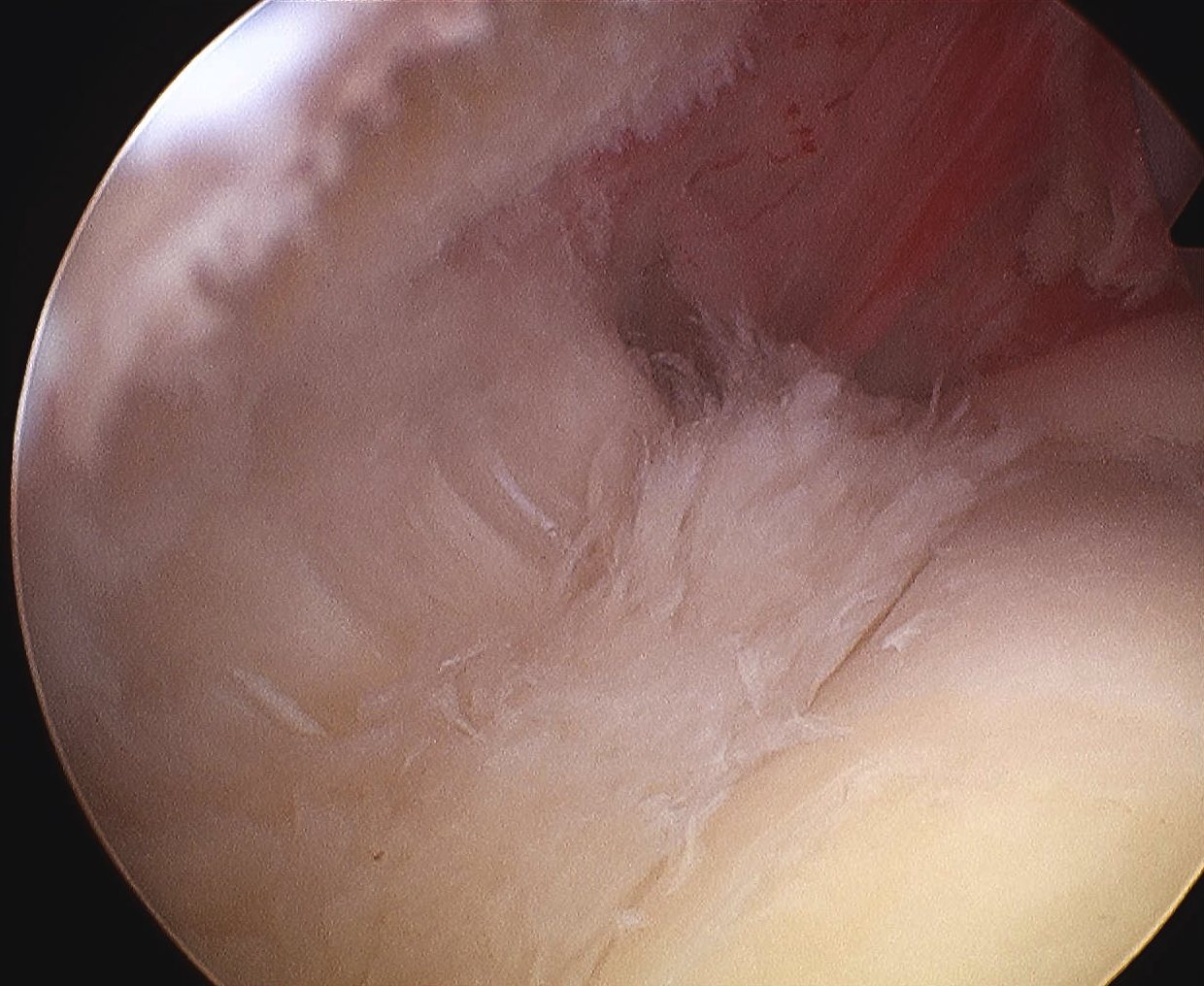 Shoulder Partial Articular Supraspinatous Tear PASTA